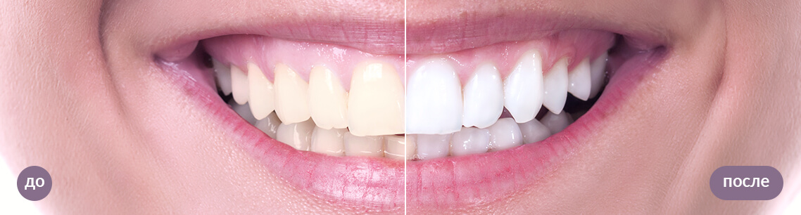 Результат <highlight>лазерного отбеливания зубов