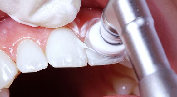 Фторирование после процедуры чистки зубов ультразвуком