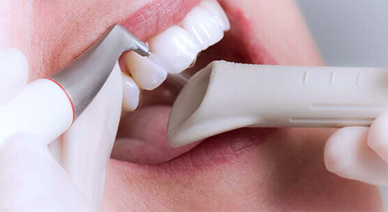 Отбеливание зубов Opalescence Томск Ручейная Покрытие зуба защитным лаком Томск Дальневосточная