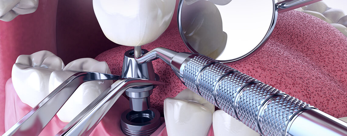 Установка зубных имплантатов Дентиум