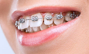 Установка металлической брекет-системы на один  зубной ряд